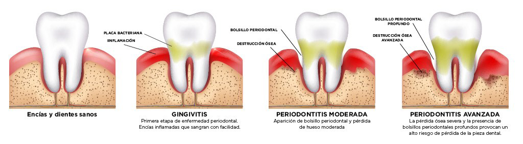 enfermedades periodontales