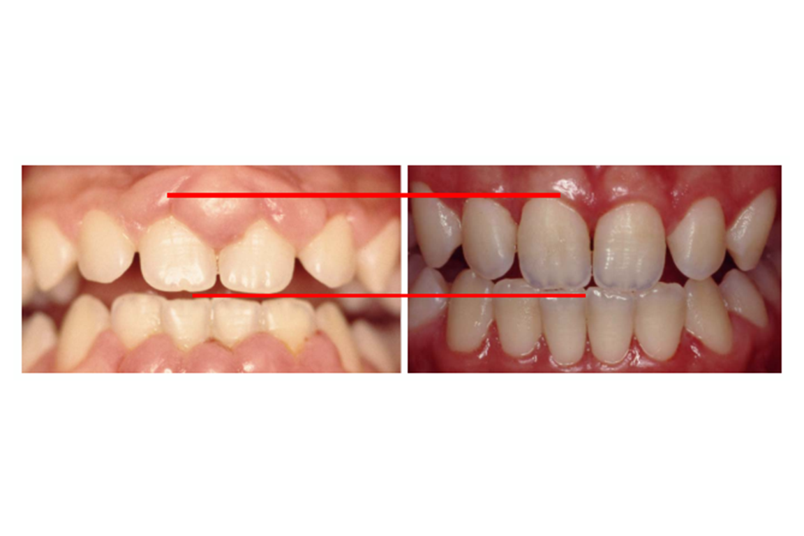 Caso-Proced Hiperplasia Ging