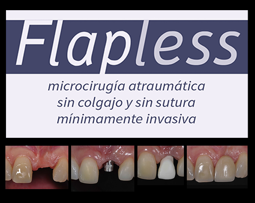 Flapless 010