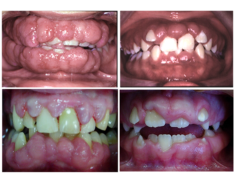 Fibromatosis X4